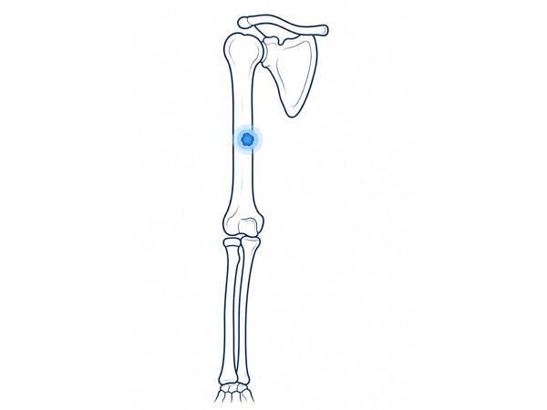 Arm Bone Tumor Arm Bone Tumor