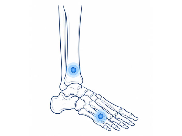 Foot and Ankle Bone Tumor Foot and Ankle Bone Tumor