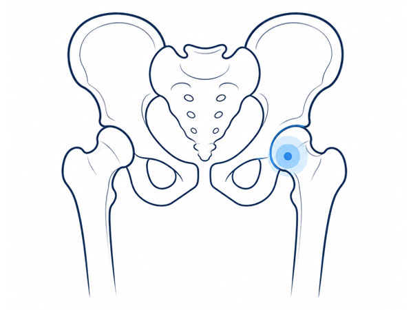 Hip and Pelvic Bone Tumor Hip and Pelvic Bone Tumor