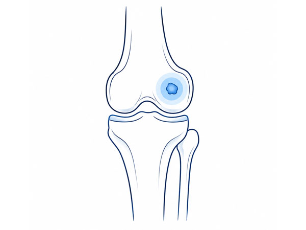 Knee Bone Tumor Knee Bone Tumor