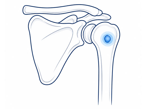 Shoulder Bone Tumor Shoulder Bone Tumor