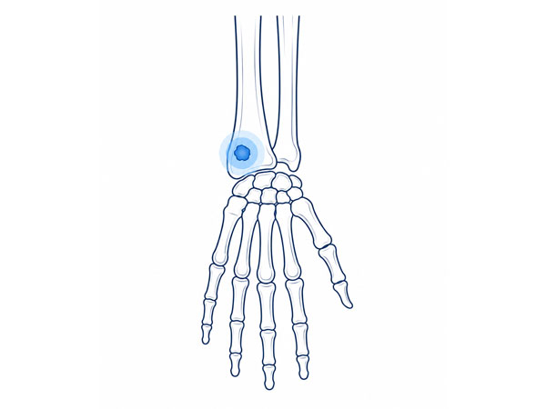 Hand and Wrist Bone Tumors Hand and Wrist Bone Tumors
